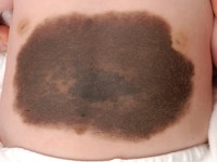 Congenitale melanocytaire naevus