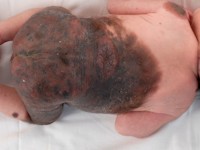 Congenitale melanocytaire naevus