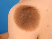 Congenitale melanocytaire naevus