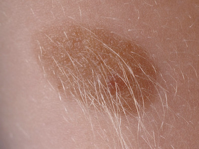 naevus naevocellularis pilosis et pigmentosus (congenital)