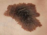 Naevus naevocellularis pilosis et pigmentosus (congenitaal)