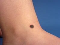 Congenitale melanocytaire naevus