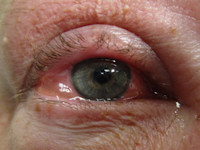 Conjunctivitis allergica