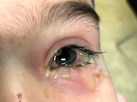 bacteriele conjunctivitis