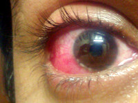 Viral conjunctivitis