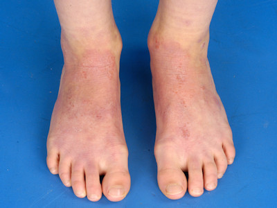 Chroom allergie leren schoenen