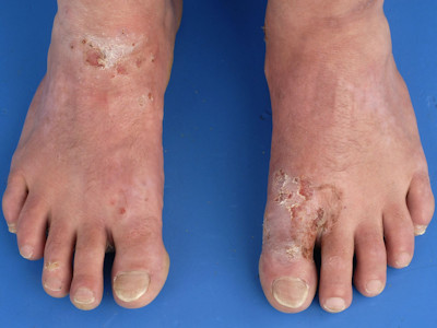 Chroom allergie leren schoenen