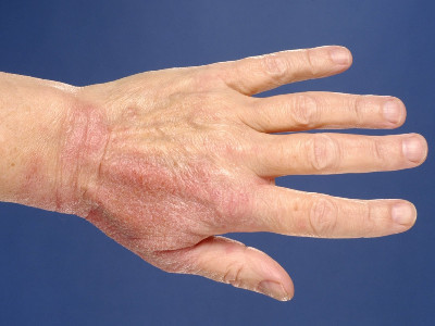 contactallergisch eczeem