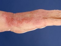 Contacteczeem door een formaldehyde releaser