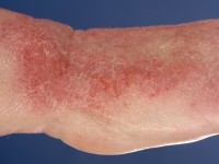 Contacteczeem door een formaldehyde releaser