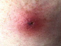 Cordylobia anthropophaga maden