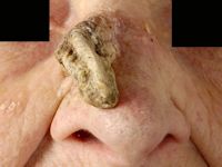 Cutaneous horn