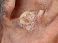 Cutaneous horn