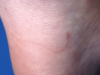 Corpus alienum (splinter)