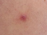 Corpus alienum (splinter)