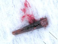 Corpus alienum (splinter)