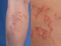 Creeping eruption (larva cutanea migrans) door Ancylostoma braziliensis