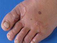 Creeping eruption (larva cutanea migrans) door Ancylostoma braziliensis