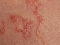 Creeping eruption (larva cutanea migrans) door Ancylostoma braziliensis