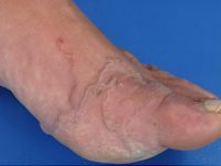 Creeping eruption (larva cutanea migrans) door Ancylostoma braziliensis