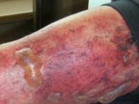 Cryoglobulinemie vasculitis