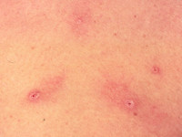 Cryptococcosis