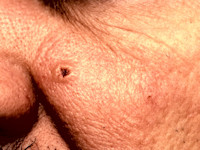 Cryptococcosis