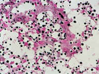 Cryptococcosis
