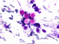 Cryptococcosis