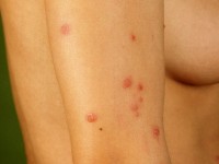 Culicosis (insectensteken)