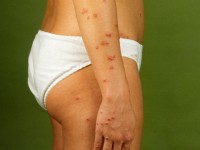 Culicosis (insectensteken)