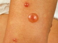 Culicosis (insectensteken)