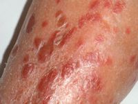 Cutaan B-cel lymfoom