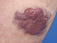 Cutaan T-cel lymfoom