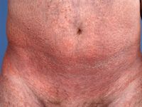 Cutaan T-cel lymfoom