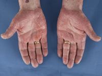 Cutaan T-cel lymfoom