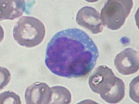 Cutaan T-cel lymfoom