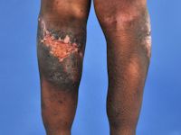 Subcutaneous panniculitis-like T-cell lymphoma