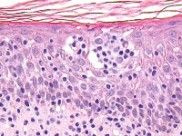 Cutaan T cel lymfoom