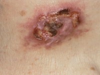 Ulcererend cutaan T-cel lymfoom