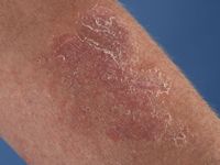 Cutaan T-cel lymfoom