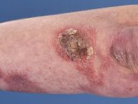 Cutaan T-cel lymfoom