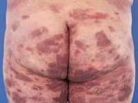 Cutaan T-cel lymfoom