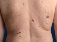 Cutaan T-cel lymfoom