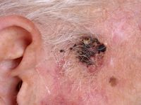 Cutaan T-cel lymfoom