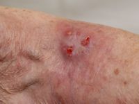 Primair cutaan anaplastisch grootcellig T-cel lymfoom