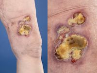 Primair cutaan anaplastisch grootcellig T-cel lymfoom