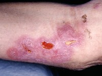 Plaques en ulcera