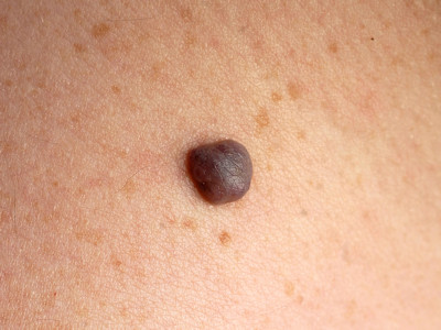 Cutaneous epithelioid angiomatous nodule