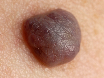 Cutaneous epithelioid angiomatous nodule